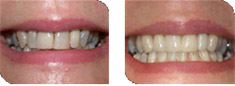 porcelain veneers