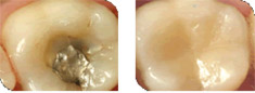 Tooth-coloured fillings