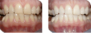 teeth-white